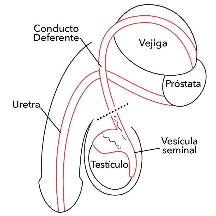 Vasectomía