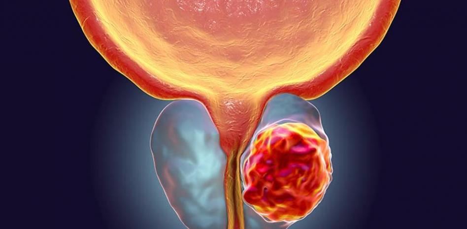 Cáncer de Próstata